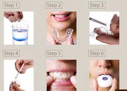 Moldable Invisible Braces Teeth Whitening Tool - JUCE