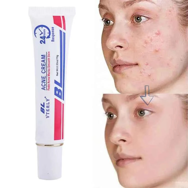 Acne Cream Scar Treatment Fast Acting - 24-Hour Spot Reduction, Anti Acne Formula, Sensitive Skin Safe, Includes Rapid Acne Scar Removal, Moisturiser, Deep Pore Cleansing - 15g - JUCE