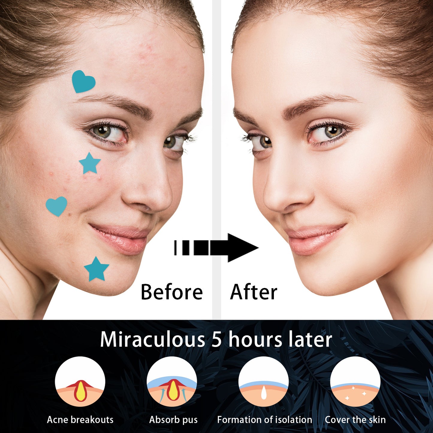 Hydrocolloid Acne Patch Cleaning Invisible And Breathable - JUCE